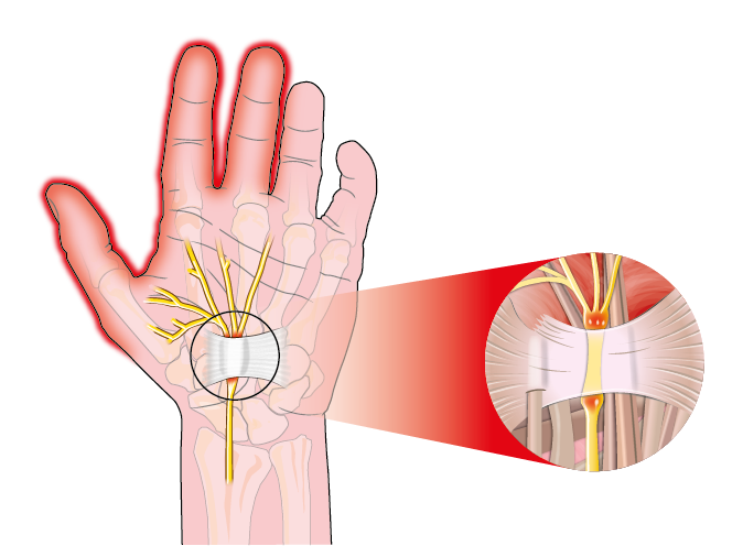 Repetitive Stress Injury, The SomaVeda® Thai Yoga Approach to Carpal Tunnel Syndrome